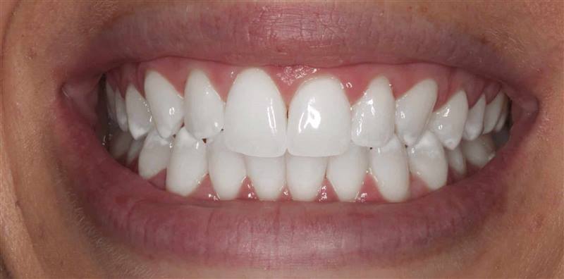 Teeth Whitening After